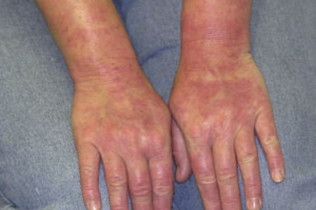 latex glove allergy