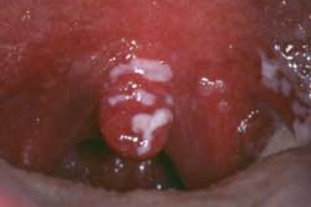 candidiasis throat