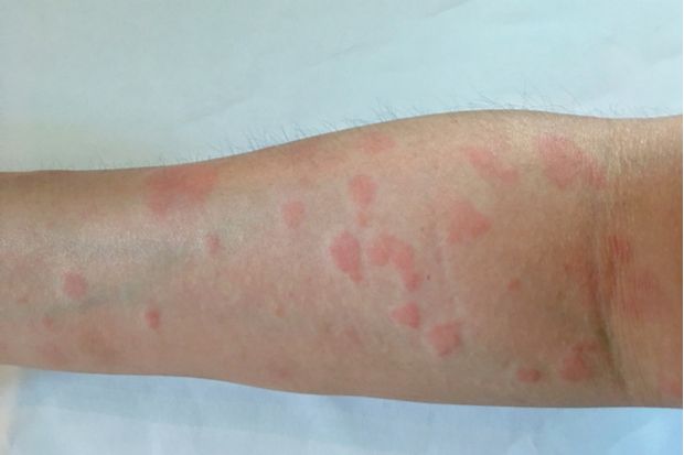 SLE is a remitting and relapsing illness that presents with non-specific symptoms, such as a rash SLE is a remitting and relapsing illness that presents with non-specific symptoms, such as a rash