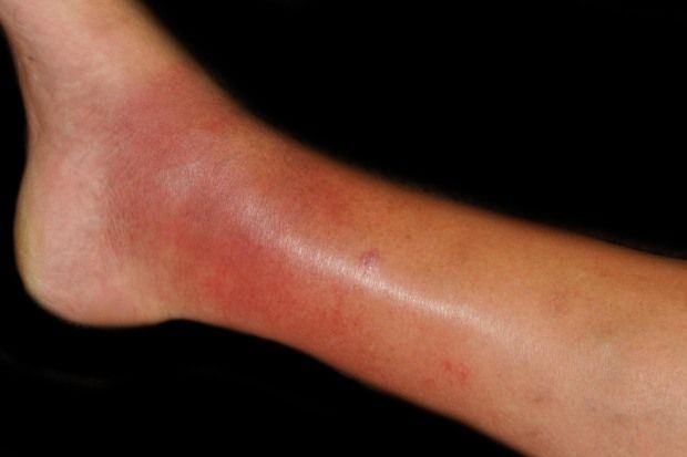 pics Pictures Of Cellulitis On Ankle cellulitis symptoms causes and