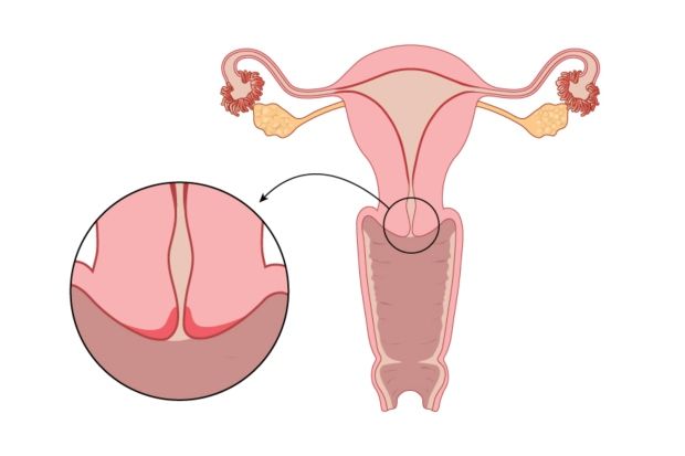 Cervical cancer is the uncontrolled development of abnormal cells in the lining of the cervix Cervical cancer is the uncontrolled development of abnormal cells in the lining of the cervix