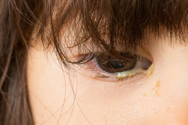 Bacterial conjunctivitis is associated with purulent discharge and crusting of the lids Bacterial conjunctivitis is associated with purulent discharge and crusting of the lids