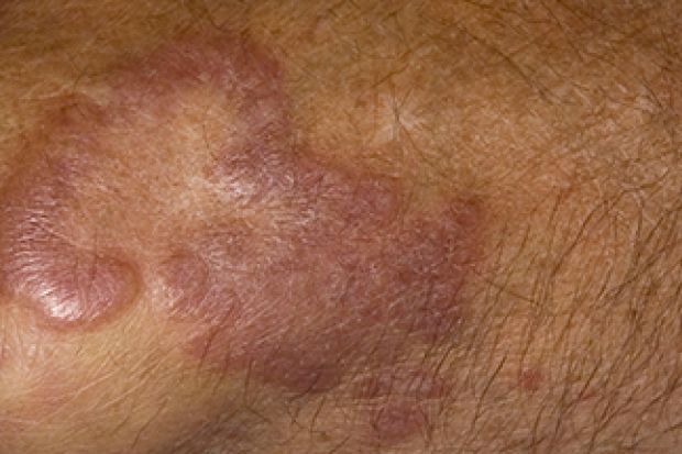 Learn About Localised Granuloma Annulare 