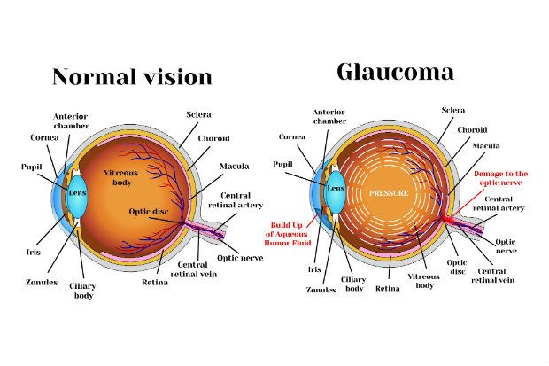 normal eye v glaucoma eye