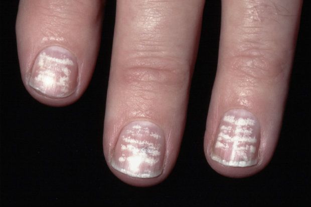 Quiz: What are these white nail lines? | Chemist+Druggist