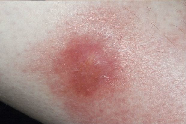 Erythema Nodosum Migrans